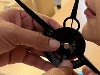 aesthetic-caliper-filler Profile facial analysis using Beauty Geometry caliper to assess chin and lip position