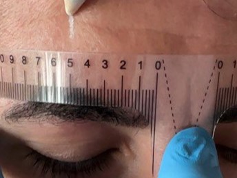 facial-analysis-botox Aesthetic injection plan showing Botox points on forehead with measuring tool