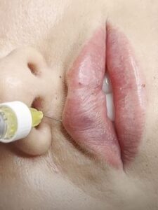 Lip filler injection for volume and shape enhancement