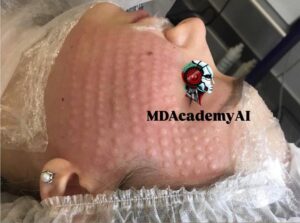 تزریق مزوژل نئویا روی صورت برای آبرسانی و درخشندگی پوست