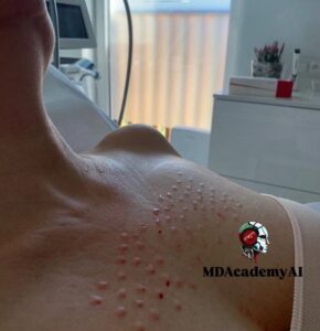 تزریق مزوژل نئویا در ناحیۀ دکلته برای بهبود ظاهر و رطوبت پوست