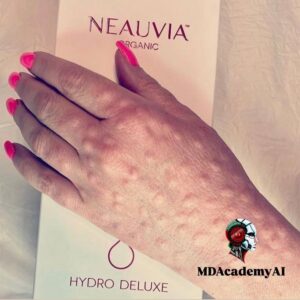 Neauvia MesoGel injection on the back of the hand for rejuvenation