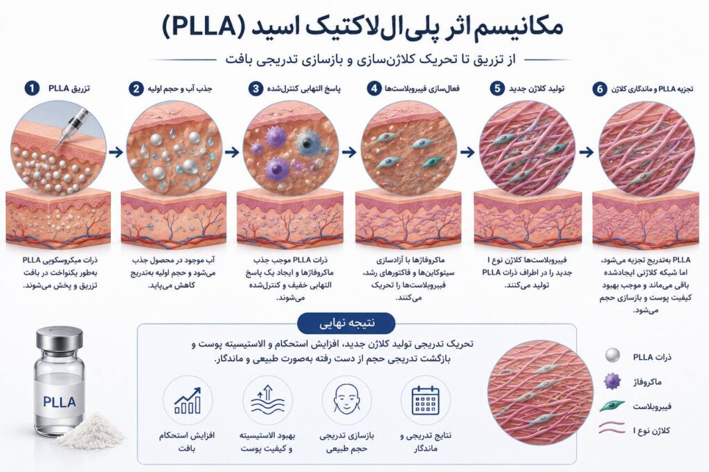 مکانیسم اثر پلیاللاکتیک اسید (PLLA) نمای شماتیک مکانیسم اثر PLLA شامل ذرات پلیاللاکتیک اسید، فعال شدن ماکروفاژها، تحریک فیبروبلاستها و تولید تدریجی کلاژن